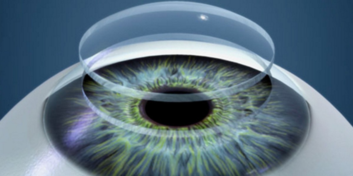 Corneal Transplant Market Global Latest Trends and Insights 2024 to 2031