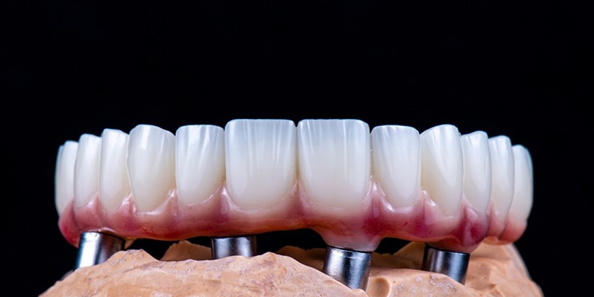 What Are The Common Issues Noticed During A Veneers First Fit?