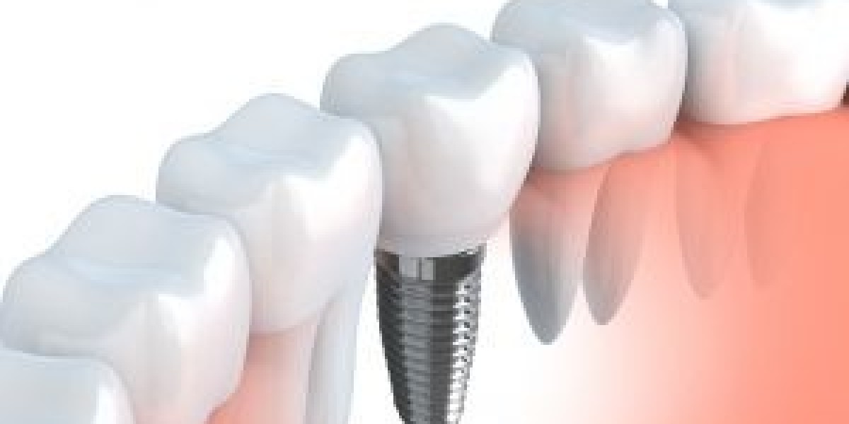 How Dental Implants in Grantham Can Transform Your Smile and Boost Confidence