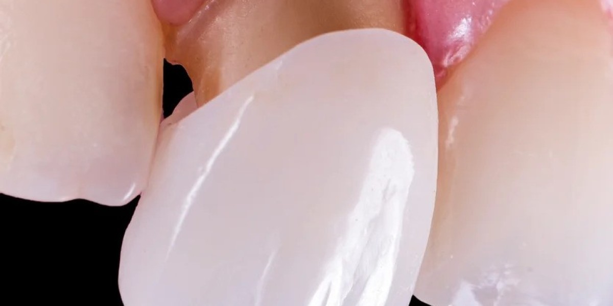 Porcelain veneers make achieving your ideal smile a reality