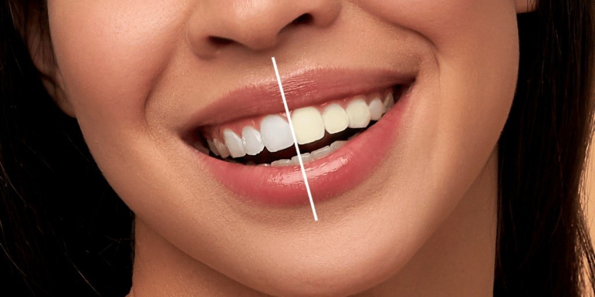 How to Maintain Your Bright Smile After Teeth Whitening