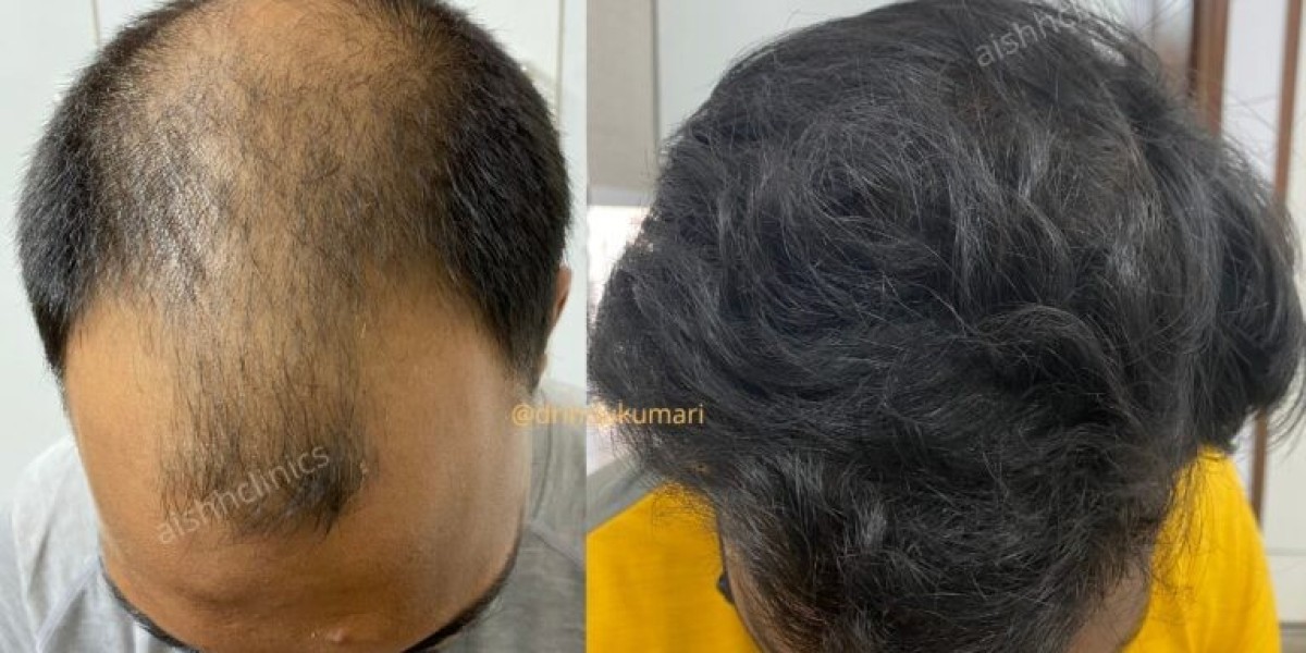 Hair Restoration in Delhi: A Comprehensive Guide to Hair Loss Treatment