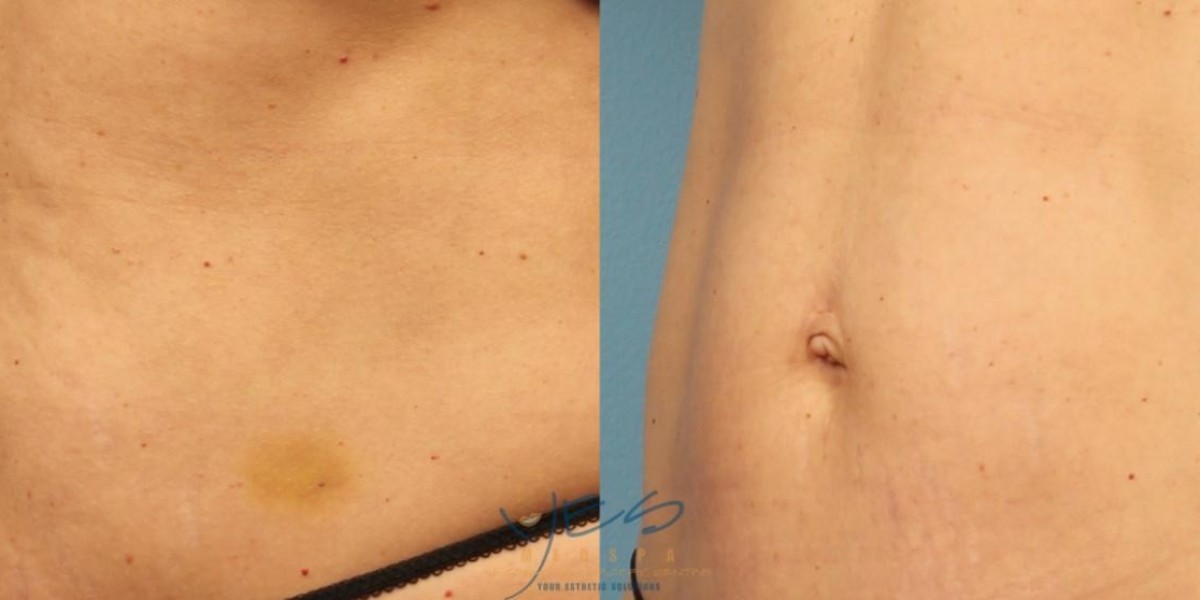 From Sagging to Stunning: How Morpheus8 Can Transform Your Abdomen