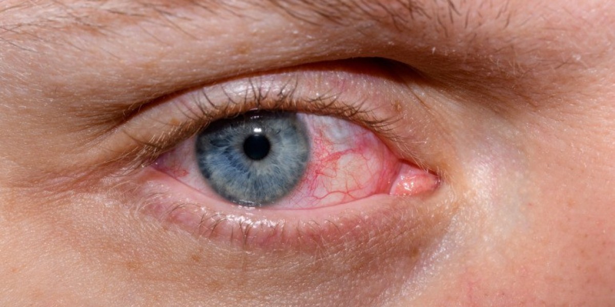 Dry Eye Syndrome Market: Key Challenges and Their Impact on Market Development