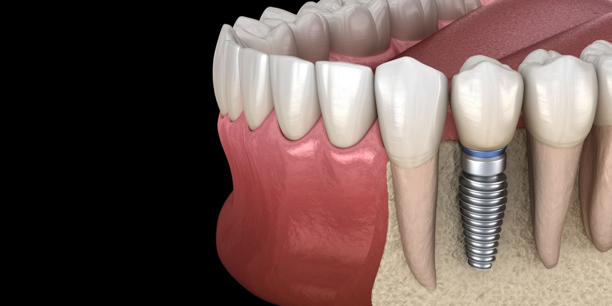 Why Choose Dental Implants in New Jersey? A Comparison of Local Alternatives