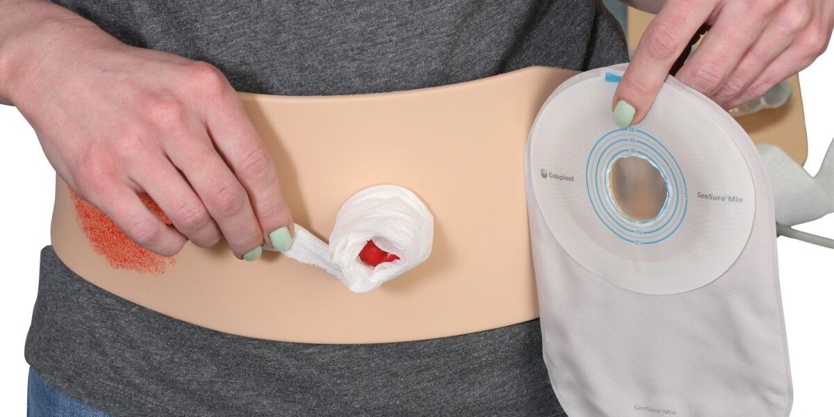 Ostomy Devices Market: Critical Factors Impacting Demand and Market Trends