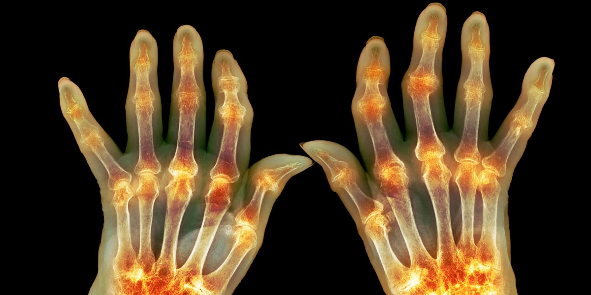 Arthritis Therapeutics Market: The Impact of Innovation on Patient Care