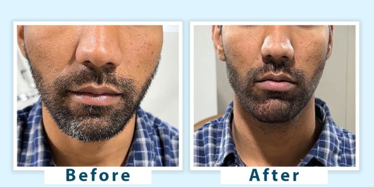 How to prevent grey beard in India