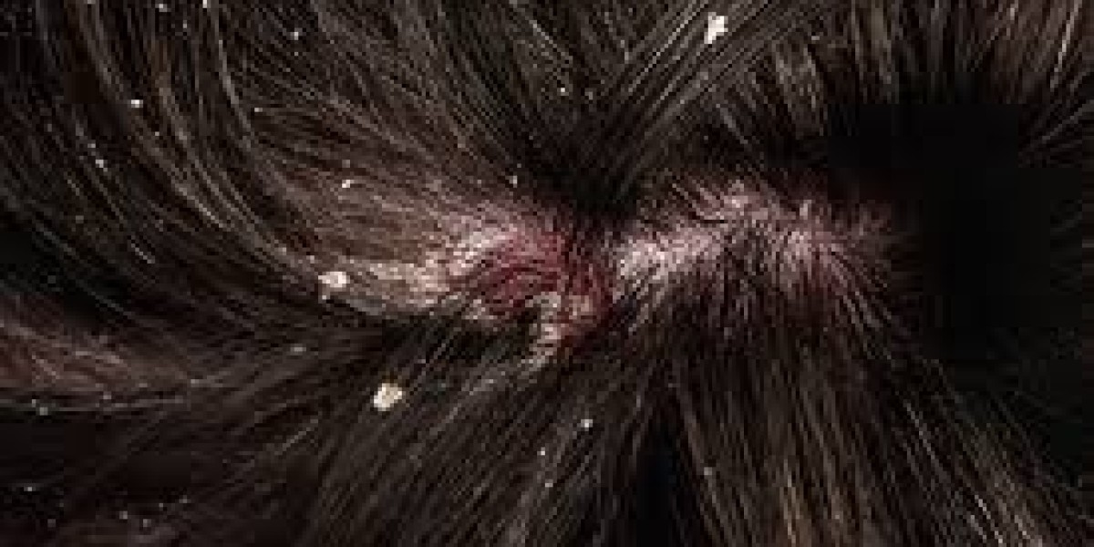 The Best Dandruff Treatment in Lahore: Expert Care at Cosmetique