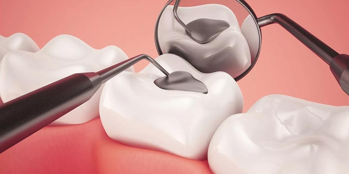 Dental Sealants Market: Winning Strategies for Growth and Innovation