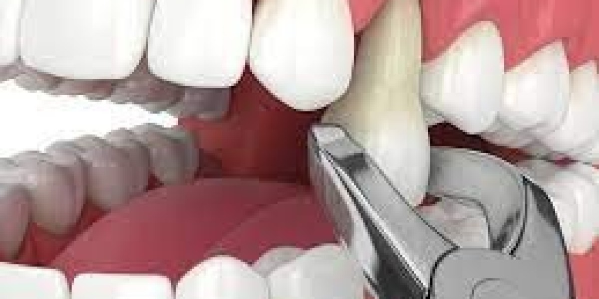 Comparing Tooth Removal Cost for Simple and Surgical Extractions