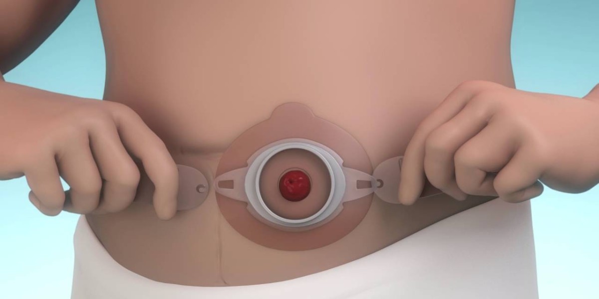 Ostomy Devices Market: Barriers Hindering Progress and Patient Care