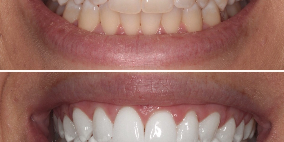 The Role of a Teeth Whitening Dentist in Smile Makeovers