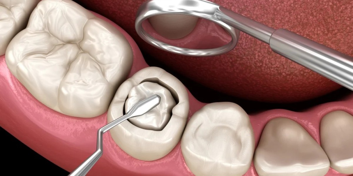 Dental Sealants Market: Forecasting Growth Through Awareness and Accessibility