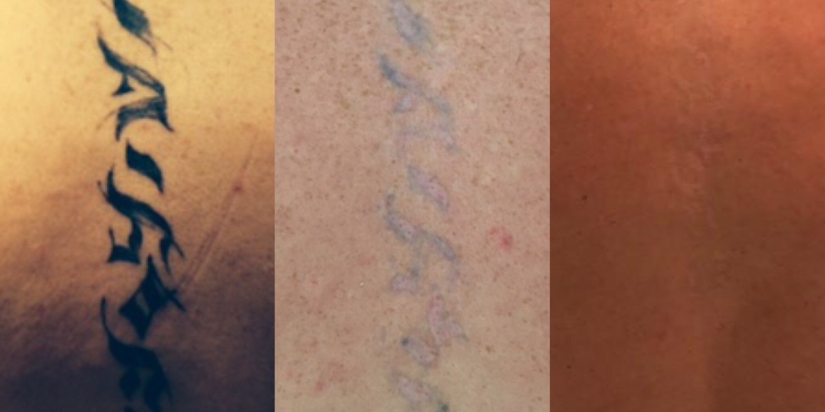 Is It Possible To Have A Complete Laser Tattoo Removal In London?