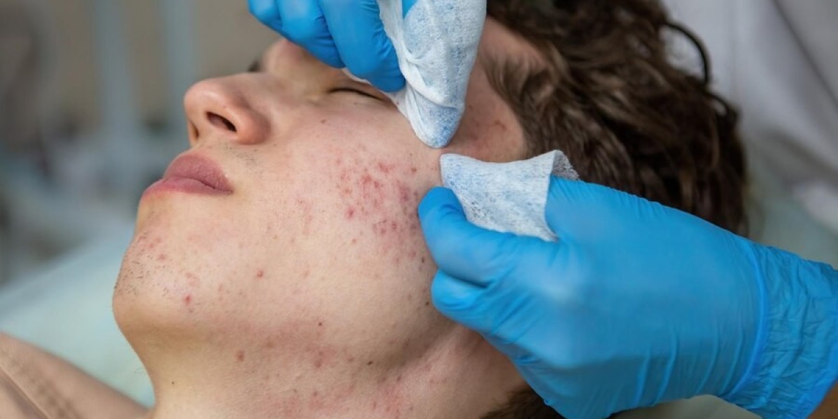 Emerging Trends in Post-Acne Scar Treatment: Market Growth and Forecasts To 2033