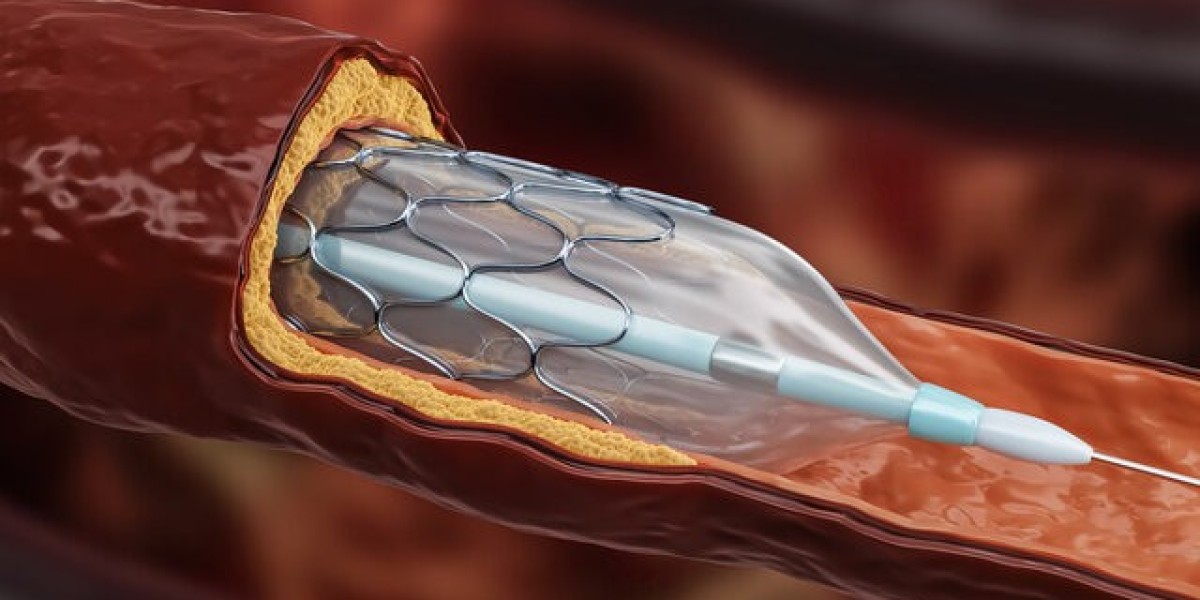 Angioplasty Balloons Market Restraints and Barriers Affecting Industry Progress