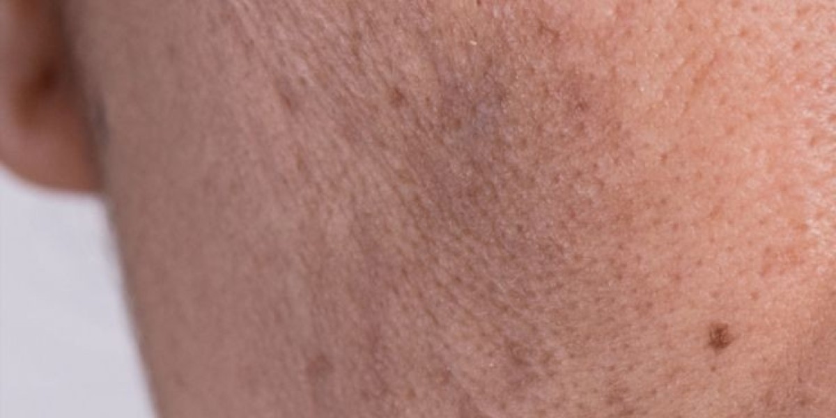 What causes skin pigmentation?