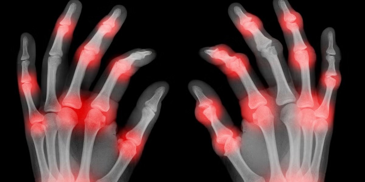 Arthritis Therapeutics Market: Key Insights into Advancements and Treatment Trends