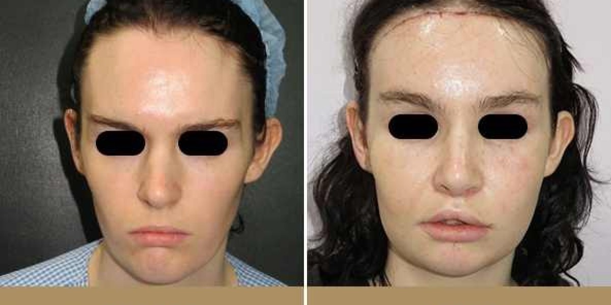 How Facial Feminization Surgery Can Change Your Life?