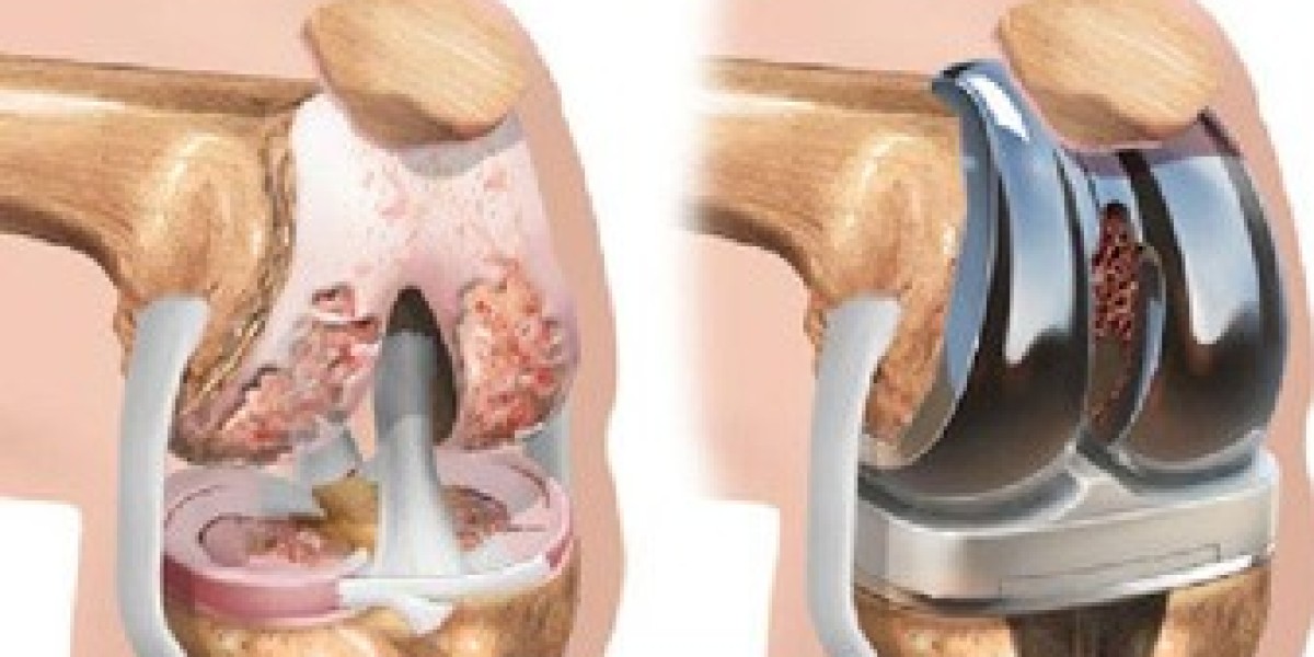 Everything You Need to Know About Knee Replacement Surgery