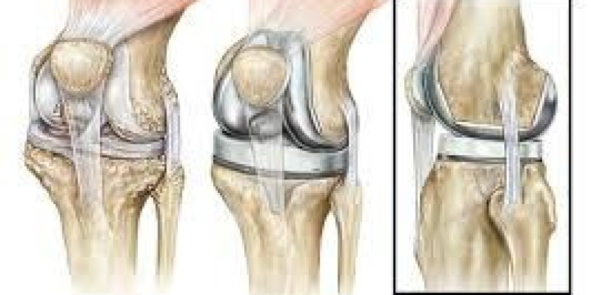 Knee Replacement Surgery: Everything you need to know