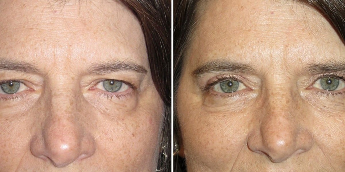 Achieve a Youthful Look with Blepharoplasty London