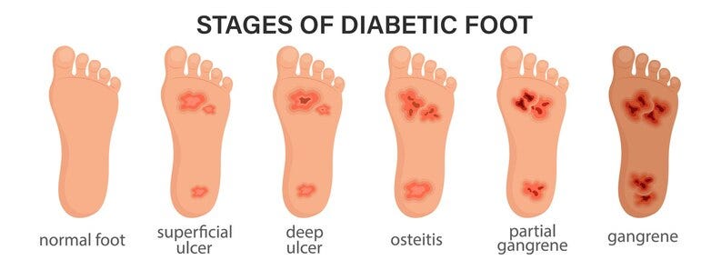 Early Stage Diabetic Foot Ulcer​: Signs, Symptoms and Treatment | by Wise RX Card | Feb, 2025 | Medium