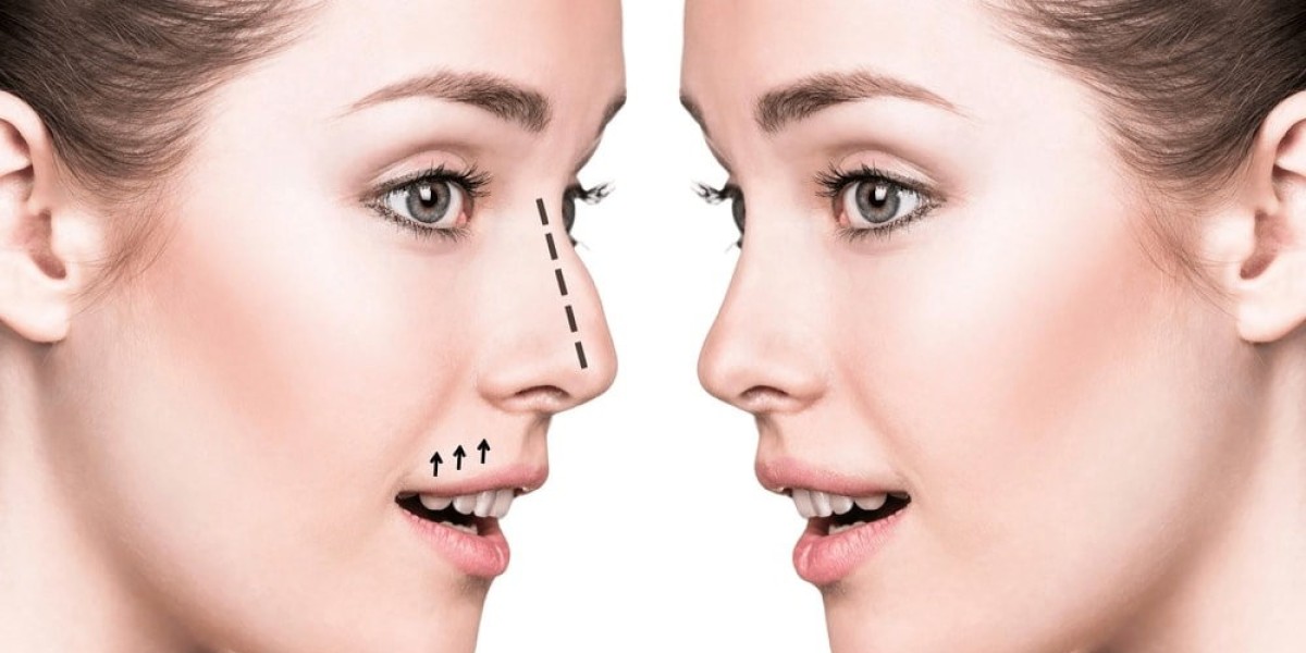 Nose Fillers Dubai: The Non-Surgical Solution for a Perfect Nose