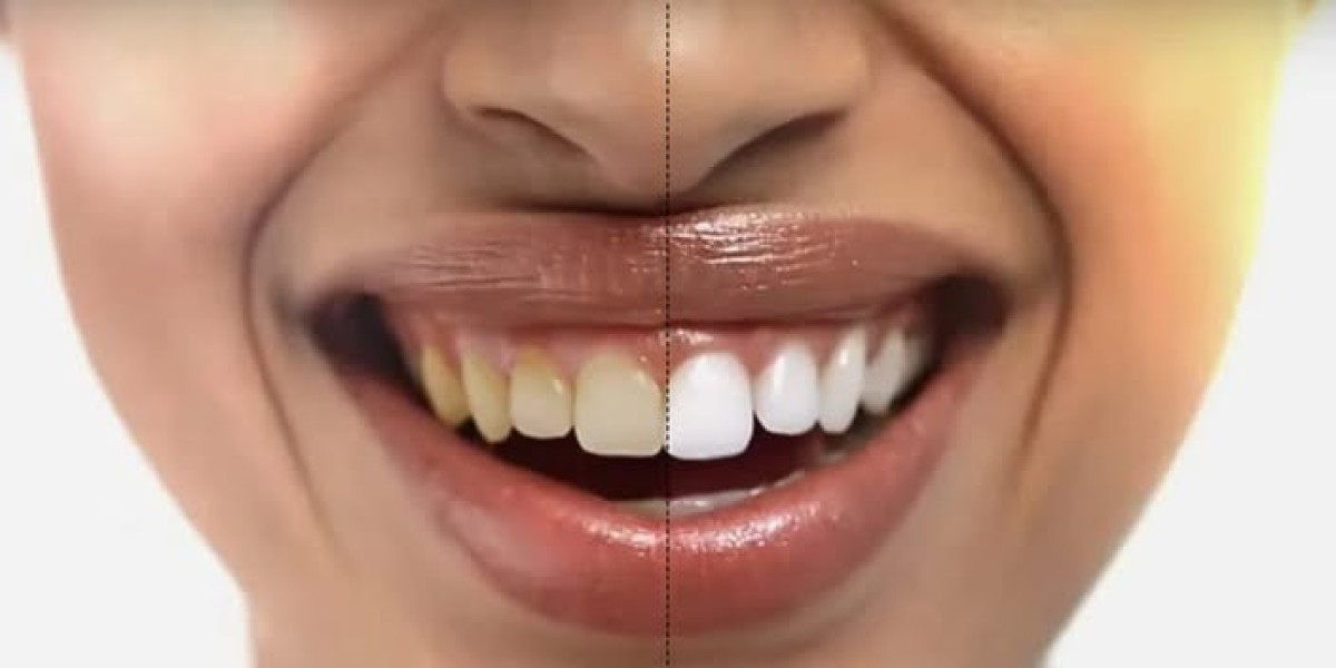 Soleil Glo Advanced Teeth Whitening Simple and Effective Teeth !