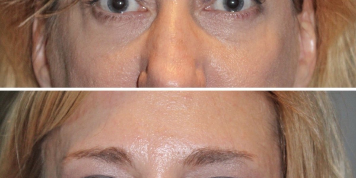 Eyebrow Lift A Comprehensive Guide to Rejuvenating Your Appearance