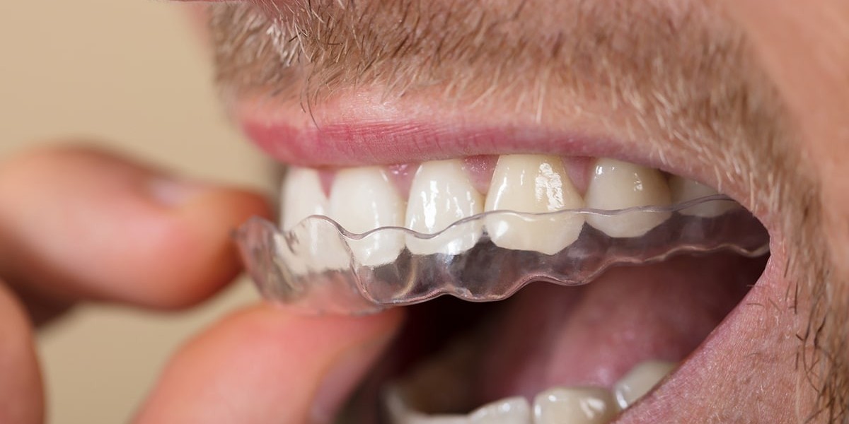 Invisalign Aftercare: How to Keep Your Aligners Clean and Clear?