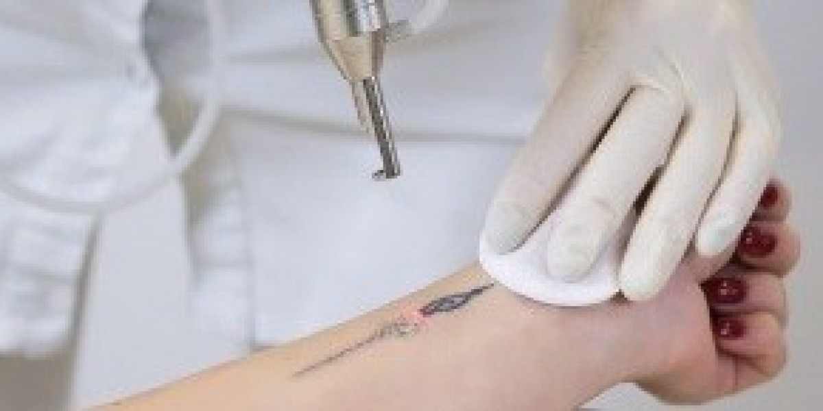 Tattoo Removal Explained: 6 Treatment Options for Different Body Parts