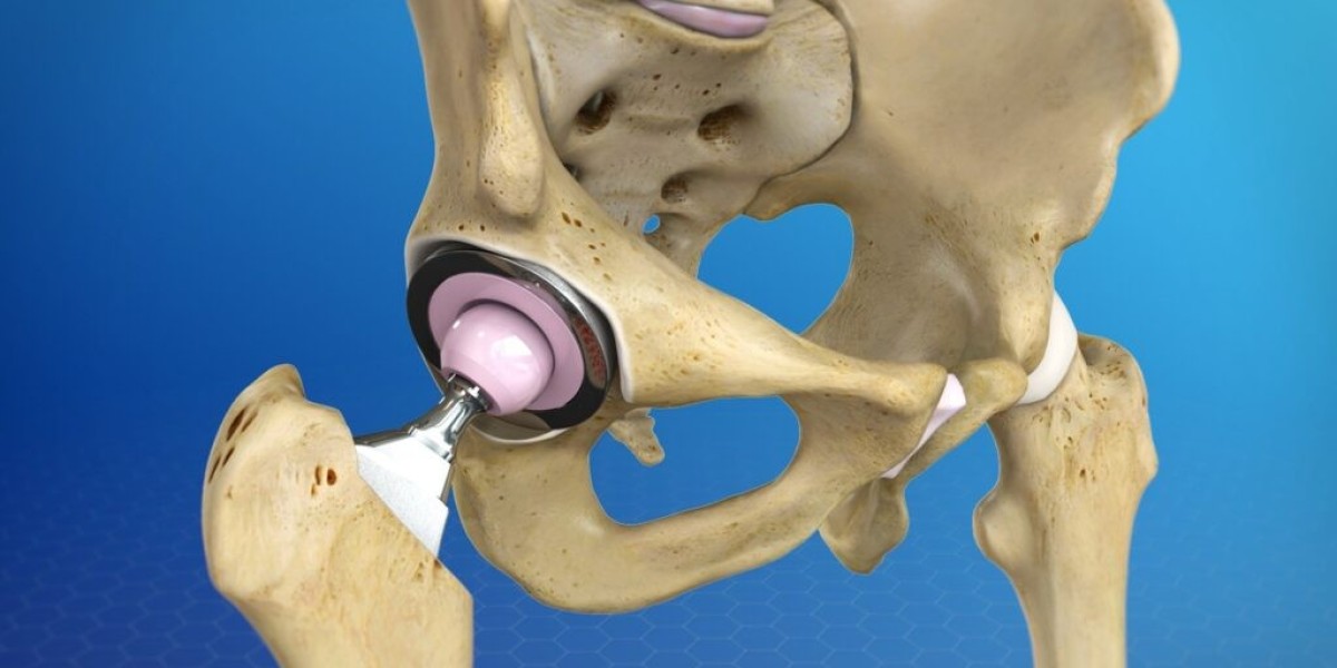 An Overview of Hip Replacement Types and Their Benefits