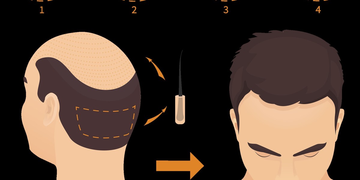 Does an FUE Hair Transplant Leave Scars? The Truth About Scarring