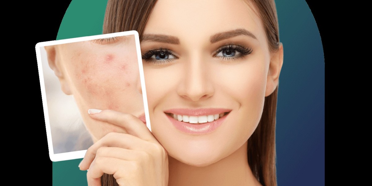 Isotretinoin 20 mg: Transforming Acne Treatment