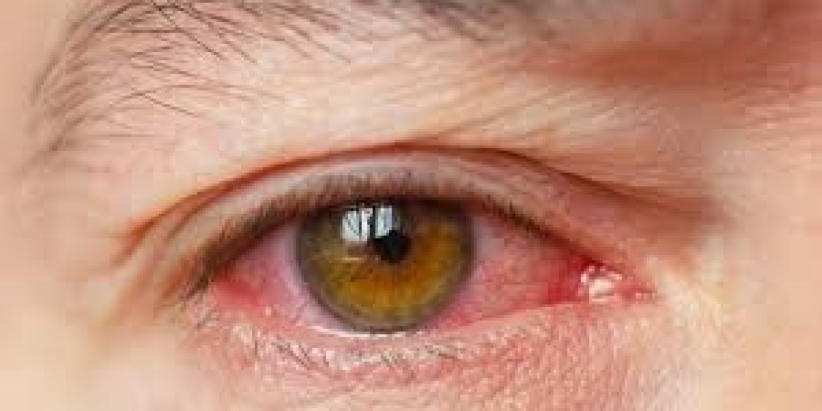 Understanding Blepharitis Treatment and How It Relates to Dry Eye Disease