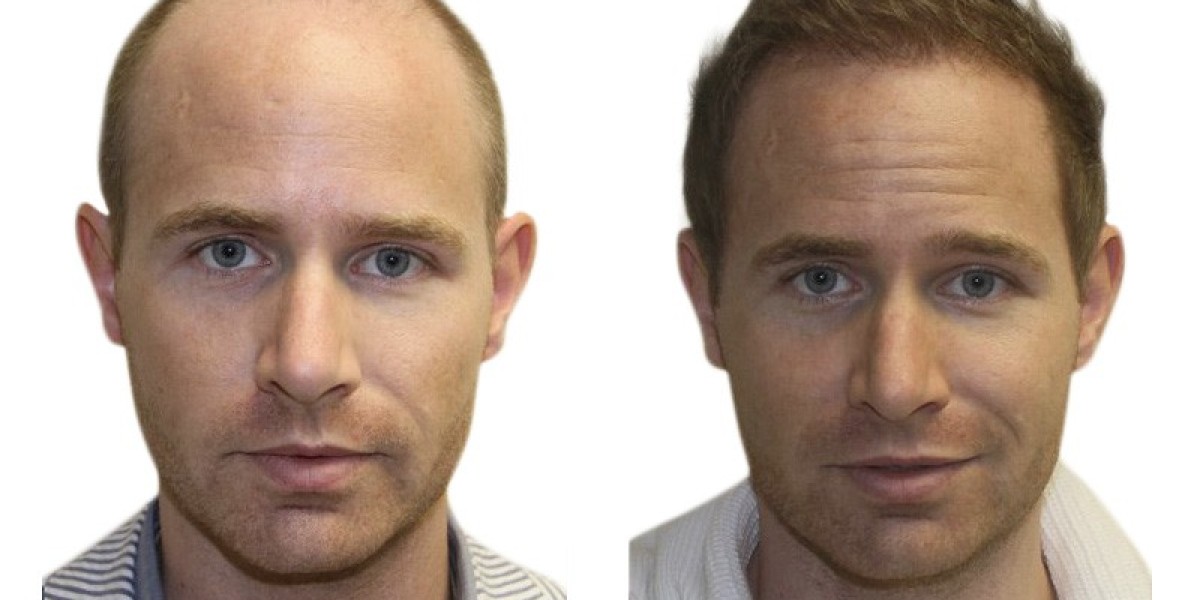 Hair Transplant London: A Solution for Hair Loss