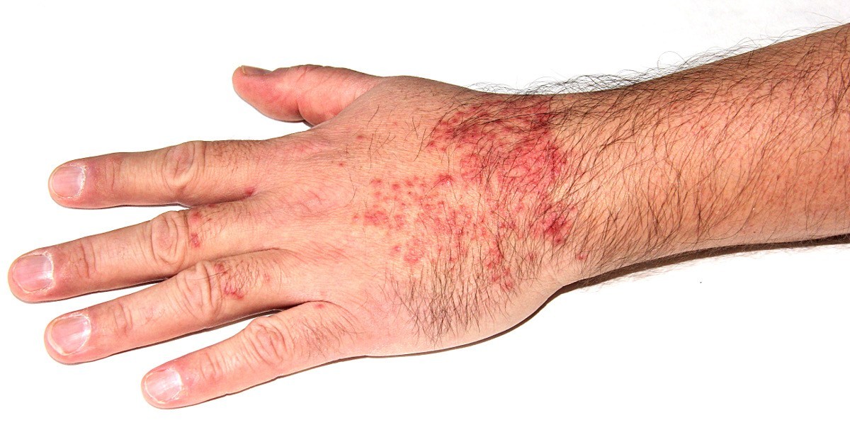 Clinical Efficacy and Market Impact: OPZELURA’s Promise for Atopic Dermatitis