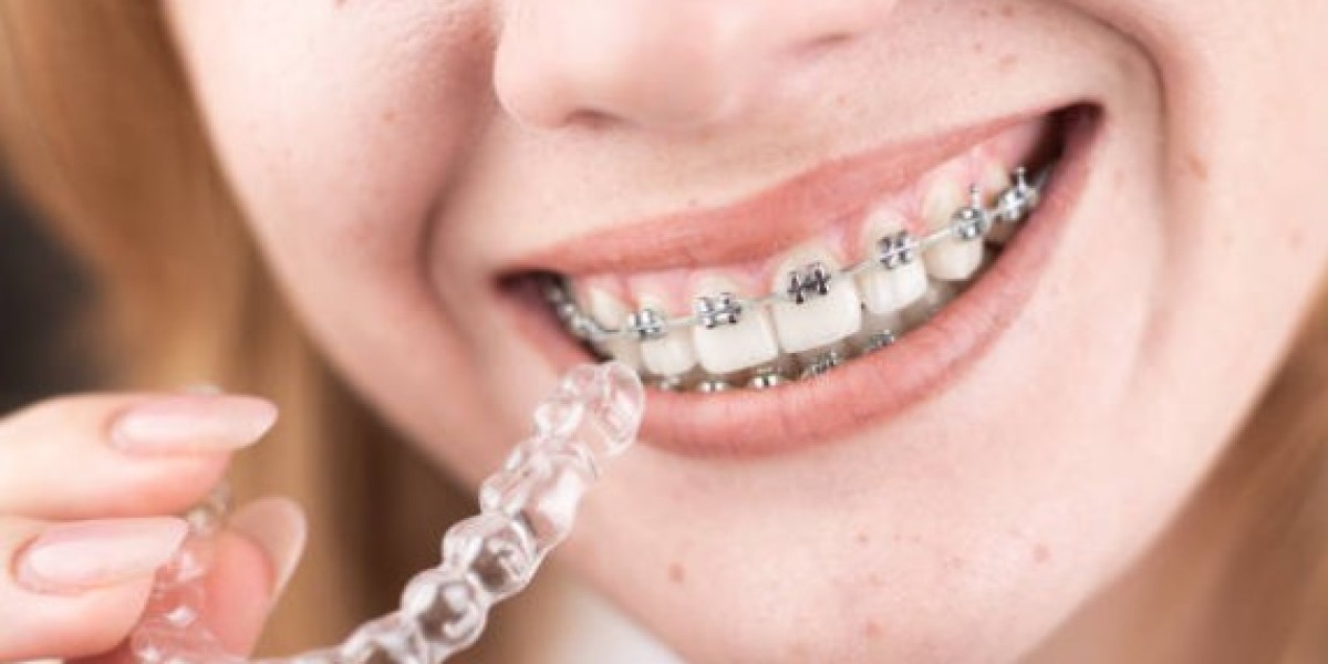 Is It Worth Buying Clear Aligners?