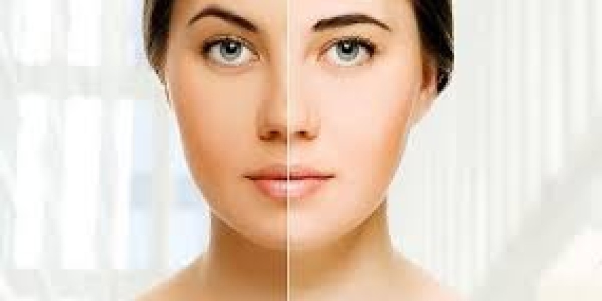 Is Skin Whitening Treatment in Dubai the Right Choice for You?