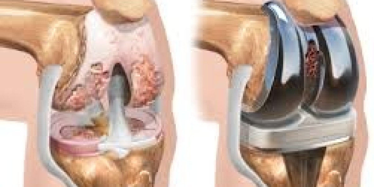 How Painful Is Knee Replacement Surgery