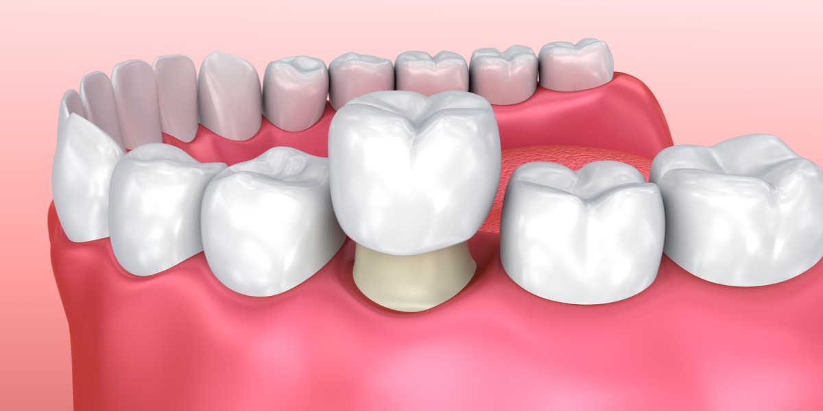 How A Dental Crown Can Save A Damaged Tooth?