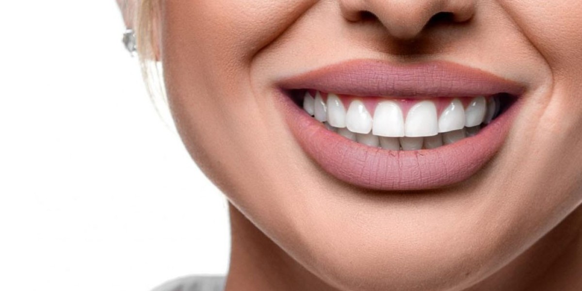 Is Hollywood Smile Dental Clinic the Best Option for Perfect Teeth?