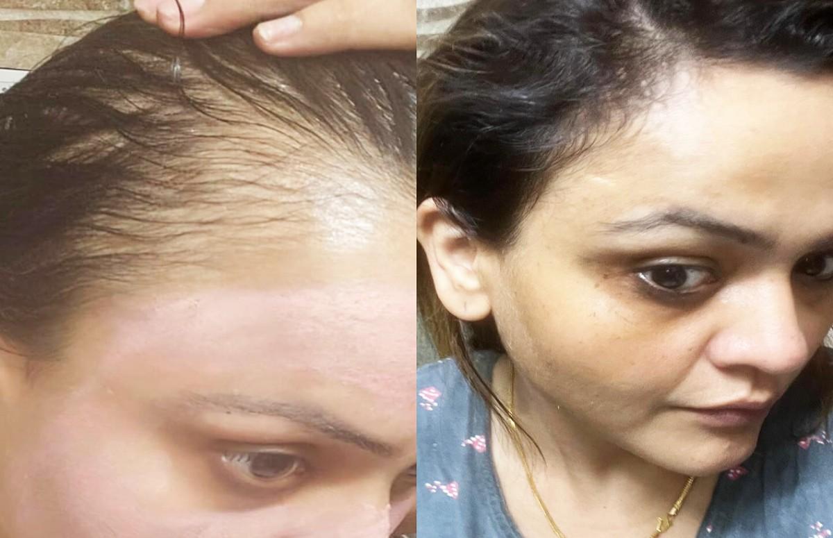 Best hair loss treatments | Nisha Lamba