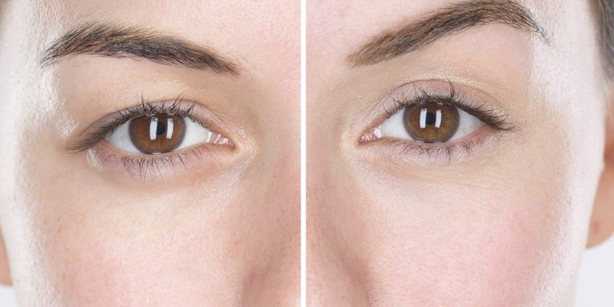 Achieving Almond Shape Eyes A Guide to Almond Eye Surgery