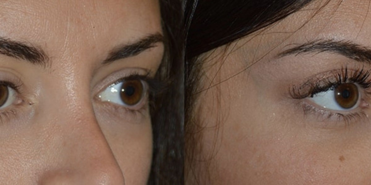 Ptosis Surgery Restoring Confidence Through Eyelid Correction