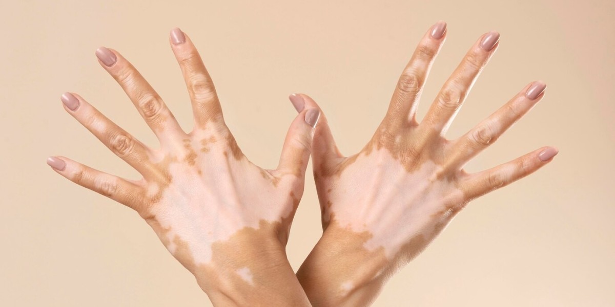 Vitiligo Treatment Market Growth, Trends, and Forecast 2033