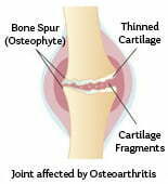 Stem Cell Therapy For Osteoarthritis & Rheumatoid Arthritis
