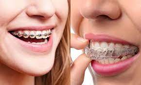 Orthodontics for Adults: Transform Your Smile with Kennesaw Orthodontist & Dallas GA Braces – Market Square Dental